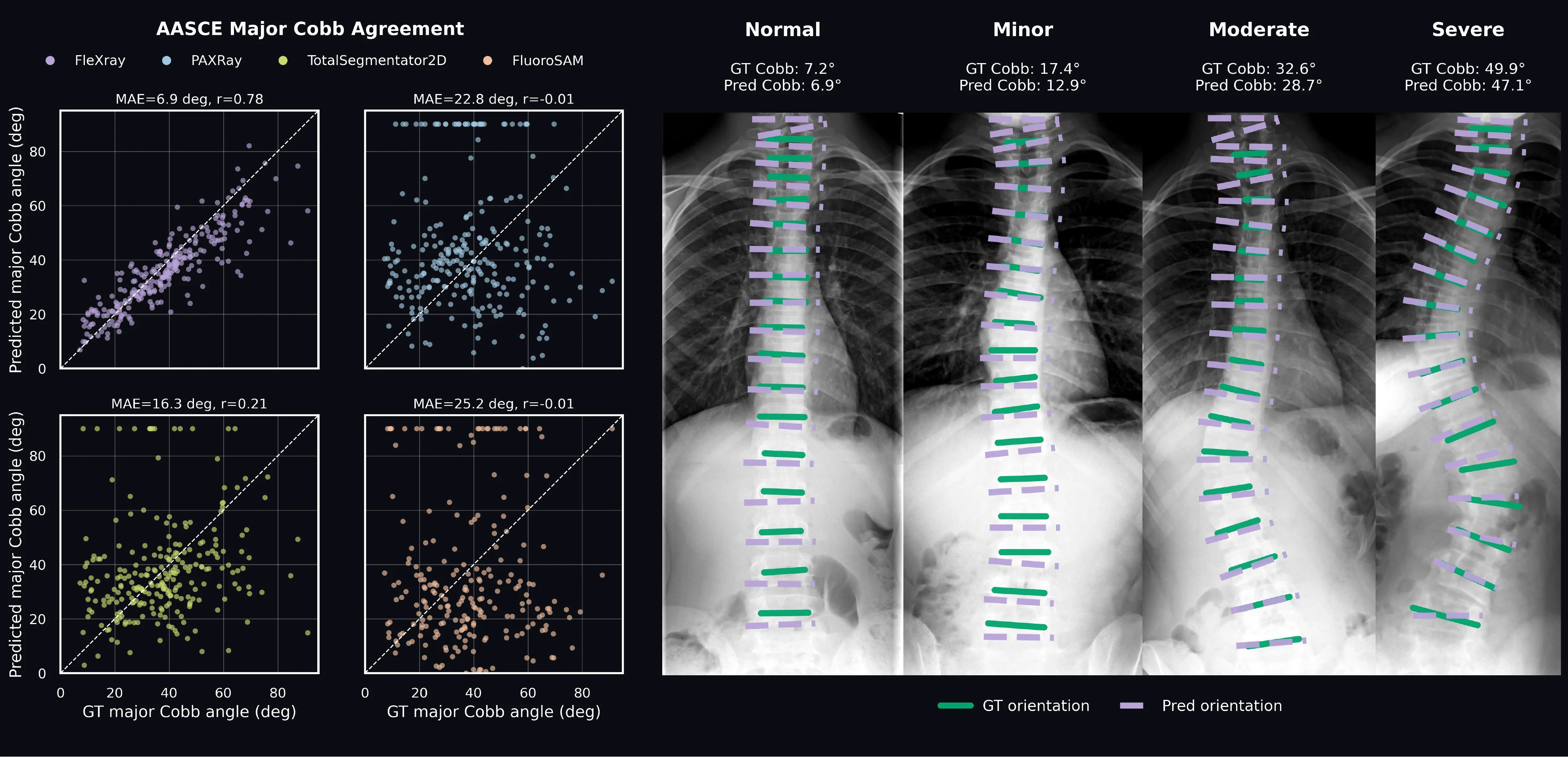 Completed scoliosis panels showing major Cobb angle agreement plots and normal, minor, moderate, and severe spine examples with reference and predicted endplate orientations.